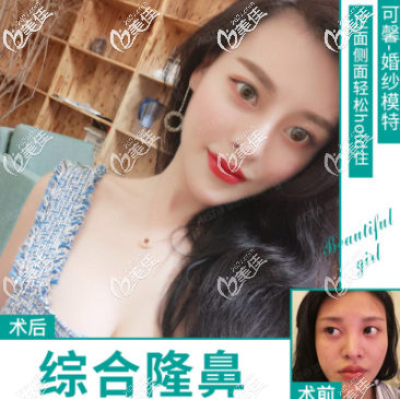 重慶愛思特真伊做鼻子好不好