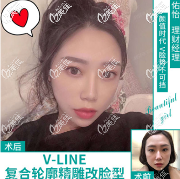 重慶愛思特袁偉面部輪廓四件套