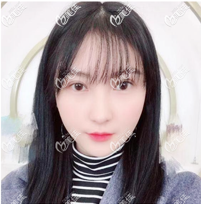 廣州美萊哪個(gè)醫(yī)生做眼睛好?看我和閨蜜分別找陳貴宗和劉志坤做的雙眼皮效果