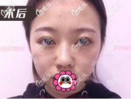 全面部脂肪填充后效果 全面部脂肪填充后效果