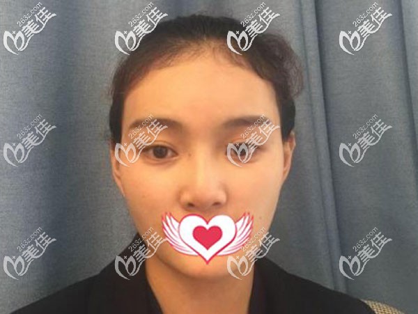 做硅膠隆鼻失敗的照片 做硅膠隆鼻失敗的照片