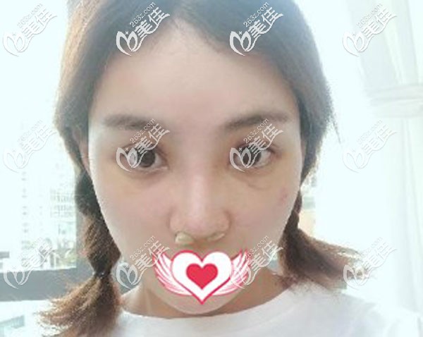 鼻修復(fù)手術(shù)第7天拆線微腫 鼻修復(fù)手術(shù)第7天拆線微腫