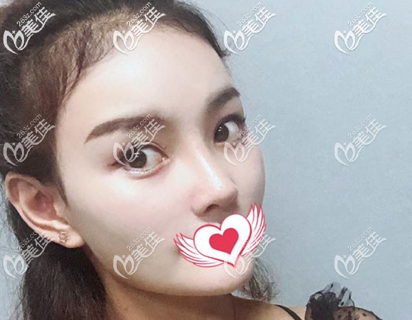 二次鼻修復(fù)2個月鼻子看起來很自然 二次鼻修復(fù)2個月鼻子看起來很自然