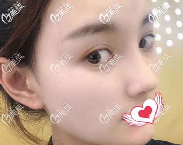 耳軟骨鼻修復(fù)一個月基本已經(jīng)定型 耳軟骨鼻修復(fù)一個月基本已經(jīng)定型