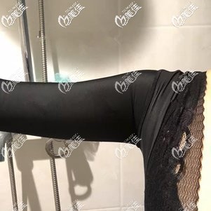 剛做完胳膊吸脂術(shù)后穿束身衣 剛做完胳膊吸脂術(shù)后穿束身衣