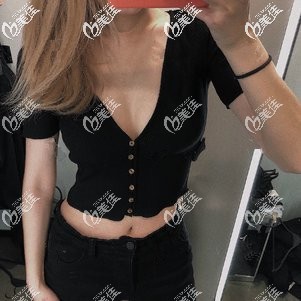 吸脂瘦手臂術(shù)后1個(gè)月胳膊變細(xì) 吸脂瘦手臂術(shù)后1個(gè)月胳膊變細(xì)