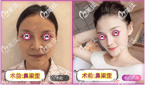 北京美萊牛永敢醫(yī)生歪鼻矯正案例 北京美萊牛永敢醫(yī)生歪鼻矯正案例