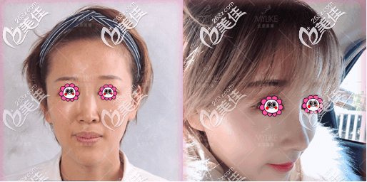 北京美萊牛永敢肋軟骨隆鼻修復(fù)案例 北京美萊牛永敢肋軟骨隆鼻修復(fù)案例