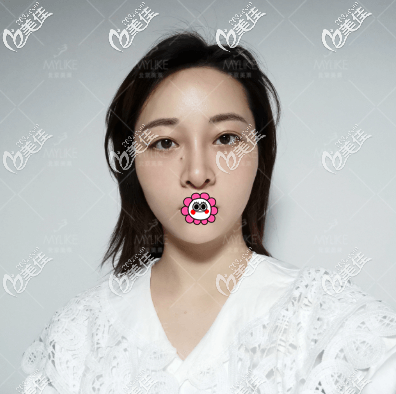 我找北京美萊<!--<i data=20240703-sp></i>-->做肋骨鼻好友說(shuō)好漂亮