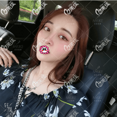 北京美萊<!--<i data=20240703-sp></i>-->做鼻子好嗎？肋軟骨隆鼻第40天效果參考