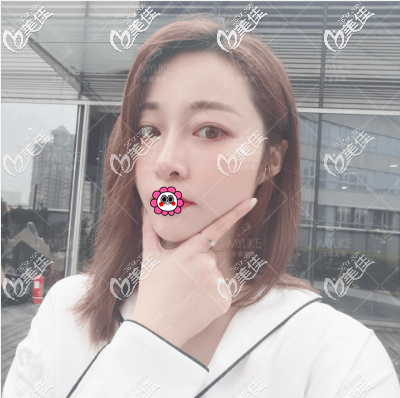 北京美萊鼻子做得怎么樣?她說我花六萬多做肋軟骨隆鼻好漂亮