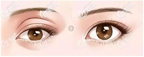 眼窩凹陷的改善效果 眼窩凹陷的改善效果