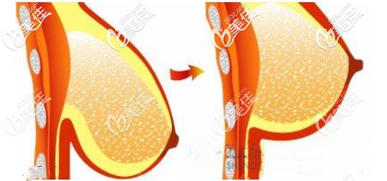 乳房下垂矯正前后效果對比照片