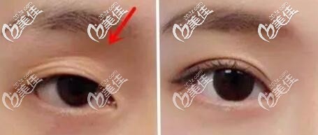 自體脂肪填充眼窩前后對(duì)比圖片 自體脂肪填充眼窩前后對(duì)比圖片