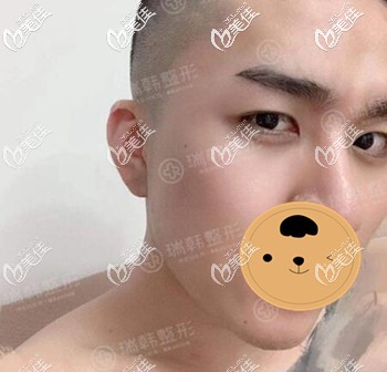 割雙眼皮術前照 割雙眼皮術前照