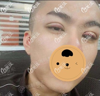 男生割完雙眼皮術后效果圖 男生割完雙眼皮術后效果圖