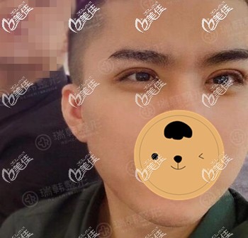 男生割雙眼皮術后5天恢復效果照 男生割雙眼皮術后5天恢復效果照