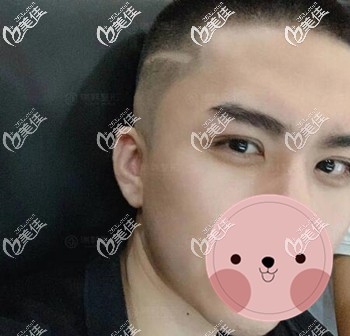 男生割雙眼皮術后30天恢復圖 男生割雙眼皮術后30天恢復圖