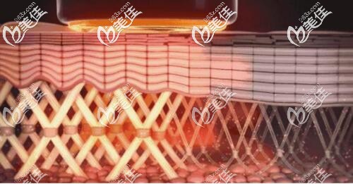 第五代熱瑪吉治療皮膚的過程示意圖