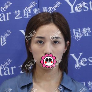 到寧波藝星做眼修復前 到寧波藝星做眼修復前