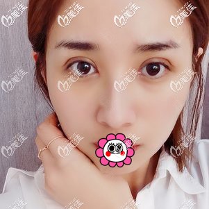 眼部修復恢復一個月效果 眼部修復恢復一個月效果