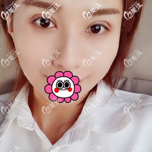 本以為雙眼皮修復(fù)會比頭次恢復(fù)的慢沒想到找寧波藝星肖慶華不僅恢復(fù)的快效果還滿意