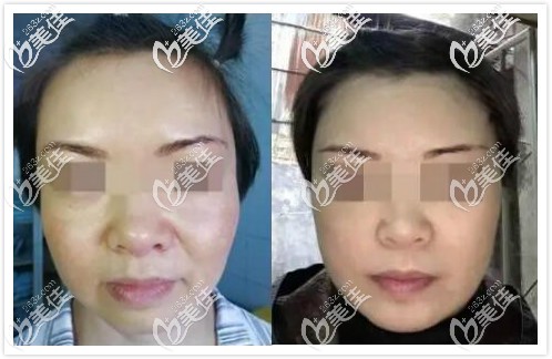 面部五層提升術(shù)真人案例效果對(duì)比 面部五層提升術(shù)真人案例效果對(duì)比