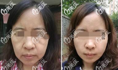 面部五層提升真人案例效果和手術(shù)價(jià)格分享 面部五層提升真人案例效果和手術(shù)價(jià)格分享