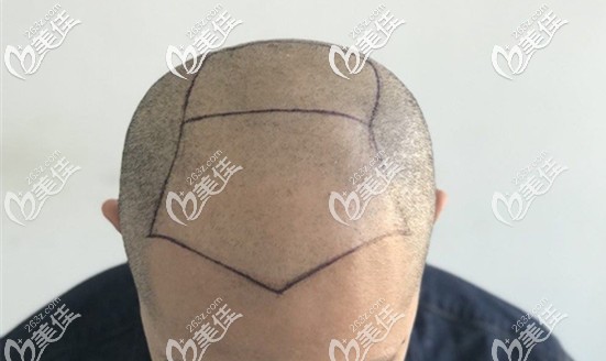 5級脫發(fā)種植4000毛囊單位效果示意圖 5級脫發(fā)種植4000毛囊單位效果示意圖
