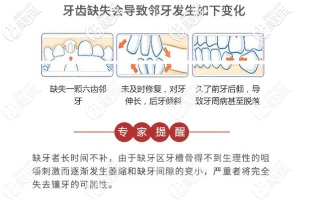 鄭醫(yī)生表示缺牙不修復(fù)危害多多