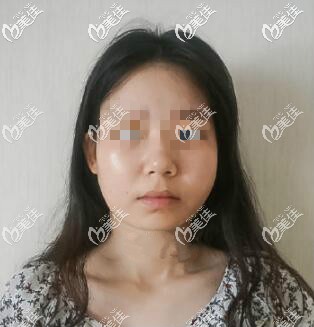 面部吸脂50天還腫沒(méi)效果圖片