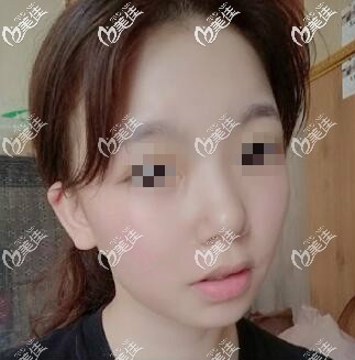 面部吸脂3個(gè)月恢復(fù)效果圖片