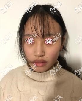 術(shù)前我的嘴巴 術(shù)前我的嘴巴