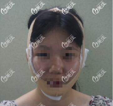 面部吸脂恢復(fù)一周過(guò)程圖片