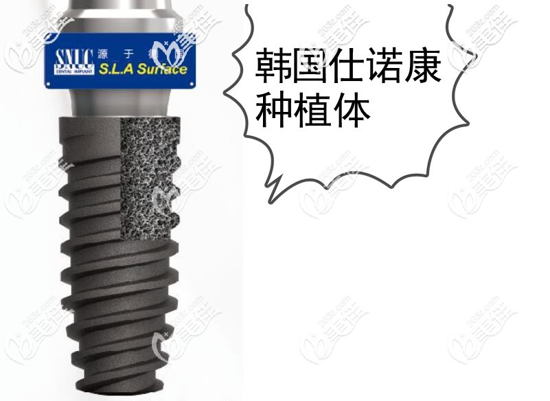 仕諾康種植體怎么樣，好不好