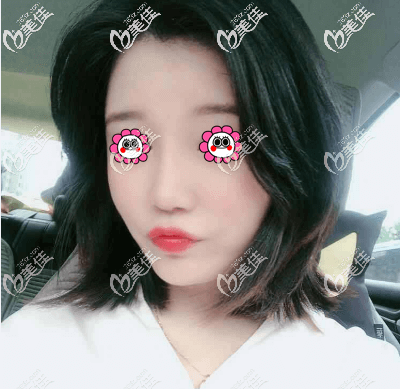 我找王東做不開刀磨骨改臉型半個(gè)月