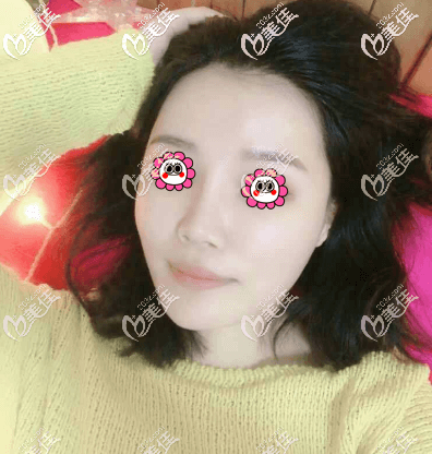 我在北京藝美做不開刀縮下頜角30天