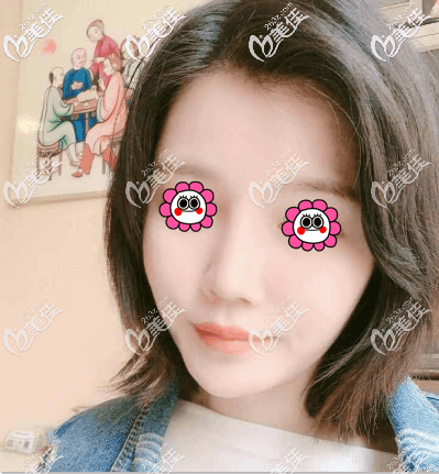 北京藝美王東不開刀去下頜角案例效果