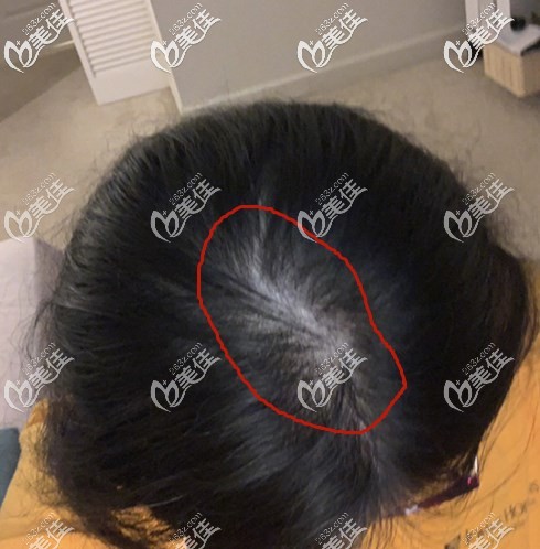 寧波薇琳植發(fā)醫(yī)院好不好?我這個做過頭發(fā)稀疏加密的人還是比較有發(fā)言權(quán)的!