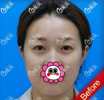 割雙眼皮術(shù)前照 割雙眼皮術(shù)前照