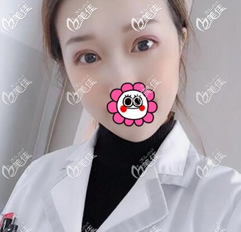 割雙眼皮術(shù)后13天效果照 割雙眼皮術(shù)后13天效果照