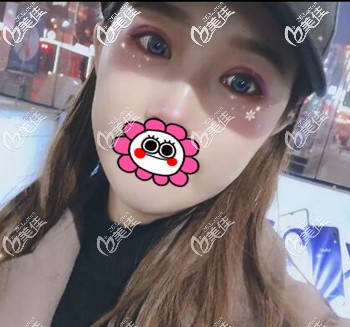 在沈陽割雙眼皮術(shù)后21天恢復(fù)效果照 在沈陽割雙眼皮術(shù)后21天恢復(fù)效果照