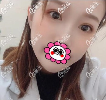 我是聽朋友說沈陽元辰陳軍院長做的元生態(tài)雙眼皮效果好所以我就找他割了雙眼皮！