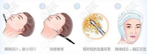 吸脂手術(shù)過程 吸脂手術(shù)過程