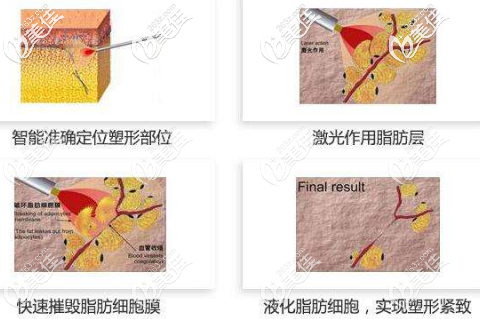 激光溶脂的過程 激光溶脂的過程
