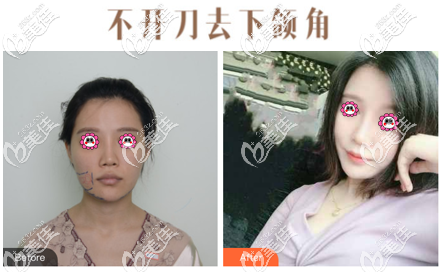 不開刀去下頜角有無(wú)后遺癥從案例效果來(lái)參考