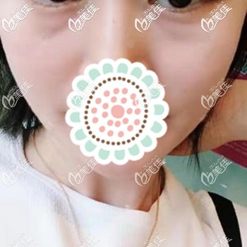 王女士兩年前有眼袋的樣子 王女士兩年前有眼袋的樣子