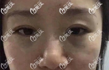 做去眼袋手術(shù)后一周可以正常工作 做去眼袋手術(shù)后一周可以正常工作