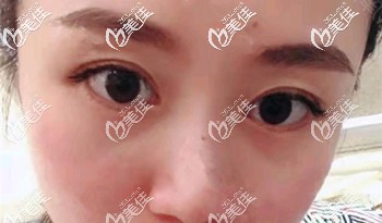 割眼袋兩周后的效果 割眼袋兩周后的效果