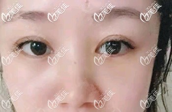 30歲的王女士在做內(nèi)切去眼袋手術(shù)二年后來說術(shù)后沒復(fù)發(fā)也沒塌陷